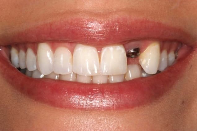 Зубные импланты на своем опыте - сроки, советы, заблуждения