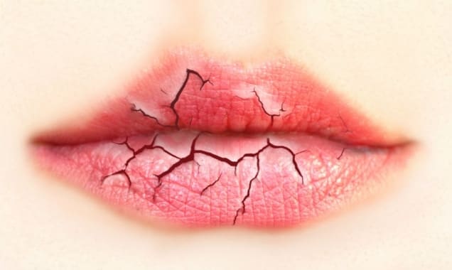Диагностируем проблемы в организме по губам - хейлит всех видов