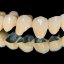 Зубы как новые: всё о восстановлении с помощью металлокерамики